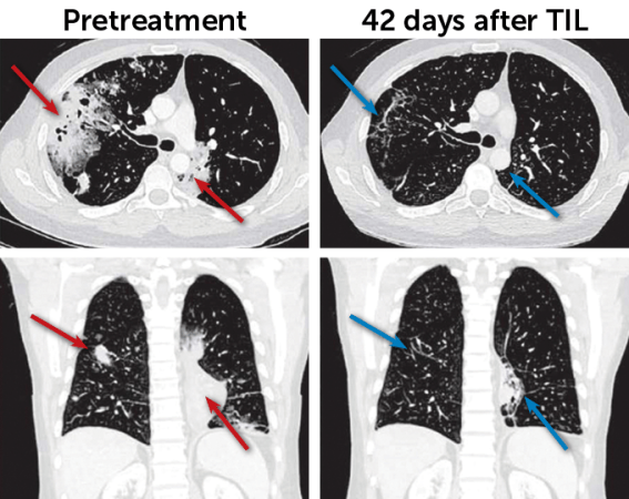 Four CT scan images, 2 comparing the pretreatment appearance of tumors and the other 2 comparing what the scan looks like 42 days after TIL